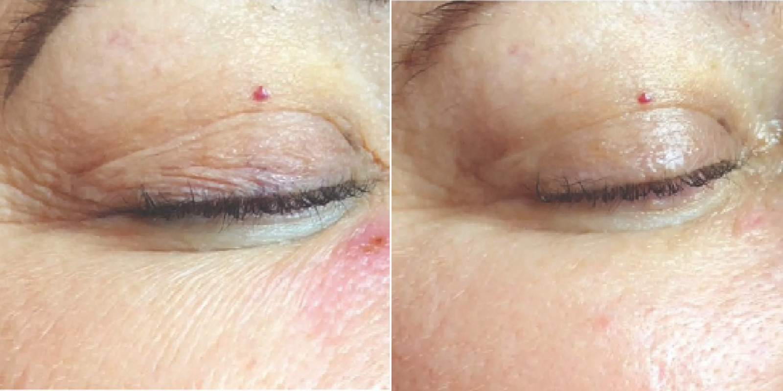 Výsledky dermatologického BioRepeel pred a po ošetrení -Príklad č. 2