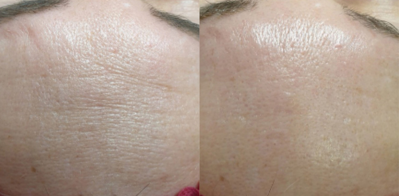 Výsledky dermatologického BioRepeel pred a po ošetrení -Príklad č. 3