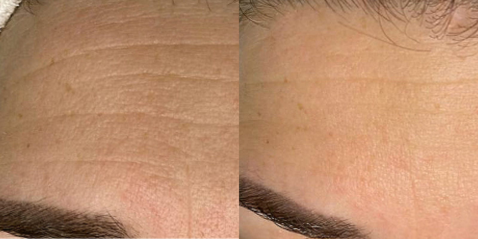 Výsledky dermatologického BioRepeel pred a po ošetrení -Príklad č. 4