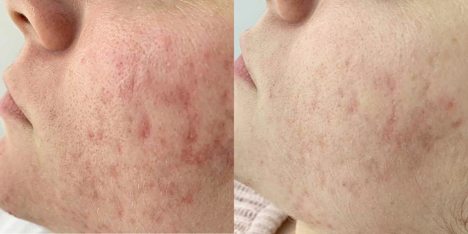 Výsledky dermatologického BioRepeel pred a po ošetrení -Príklad č. 5