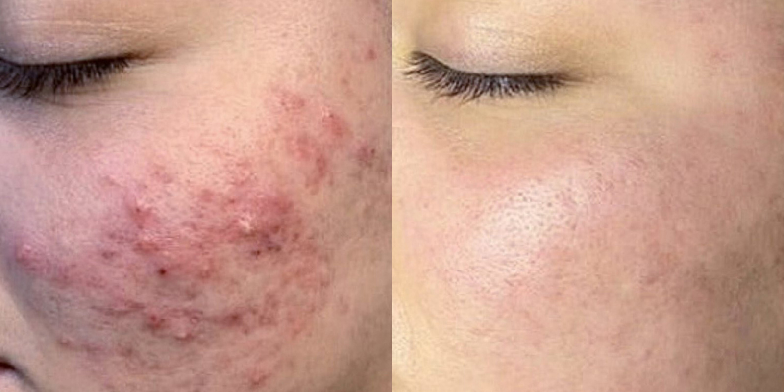 Výsledky dermatologického BioRepeel pred a po ošetrení -Príklad č. 7